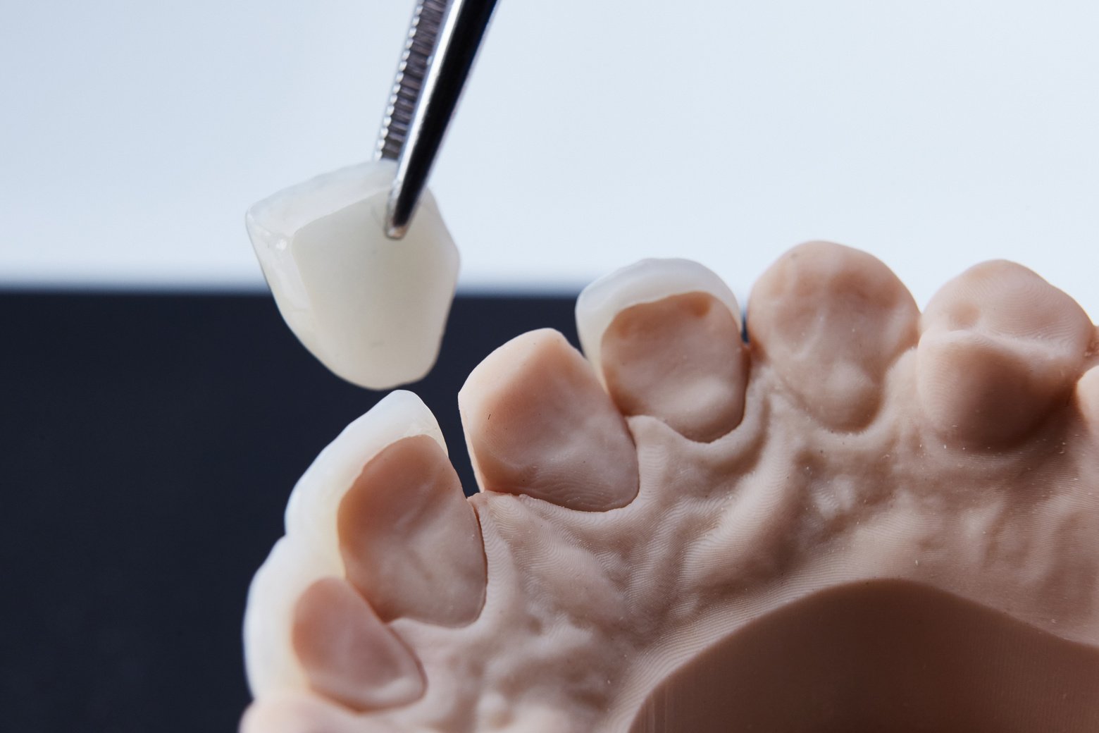 Application of Ceramic Dental Veneers Up Close